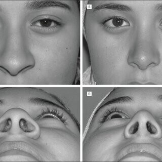 Az orrlyuk-tágulás folyamata látható különböző szögekből.